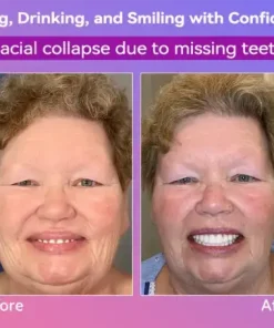 Latest Premium Comfort Dentures