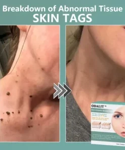 MicroNeedle Botanic skin Tag Removal Patch