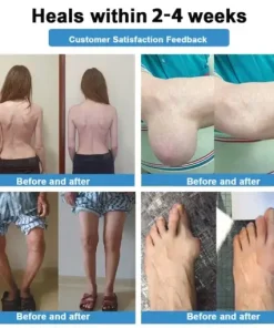 Nano-Microneedle Joint Patch