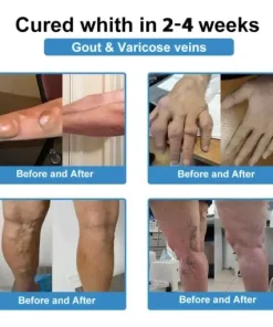 Nano-Microneedle Joint Patch