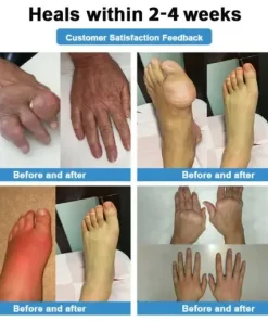 Nano-Microneedle Joint Patch