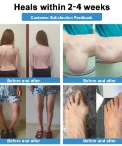 Nano-microneedle joint patch