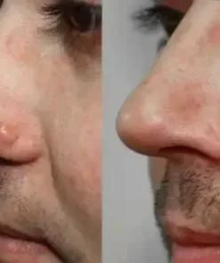 Natural Skin Tag and Wart Removal Patches