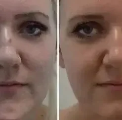 Natural Skin Tag and Wart Removal Patches