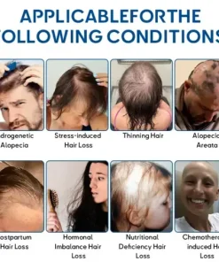 STEM Cell Hair Cycle Roller