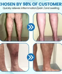 VascuCare Vein Healing Spray