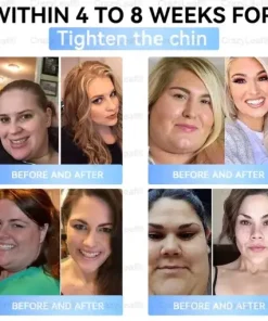 𝐒limming & 𝐻ealth 𝑁ano 𝑀icroneedle 𝑃atch