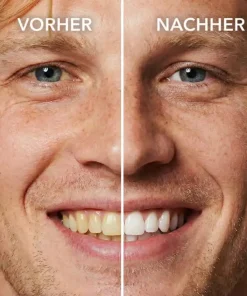 Misspone™ Tooth Polish - Instant Clean Smile