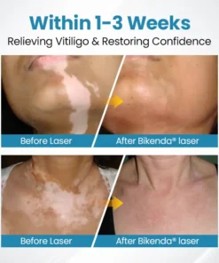 Bikenda® DermaBeam Vitiligo Therapy Device