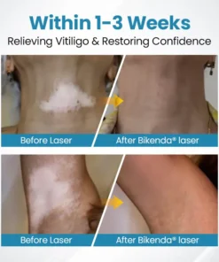 Bikenda® DermaBeam Vitiligo Therapy Device