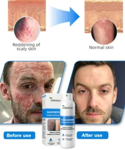 HOBENSUN® Magnesium Herbal Psoriasis Spray