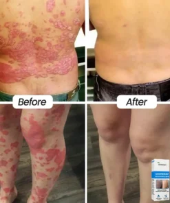 HOBENSUN® Magnesium Herbal Psoriasis Spray
