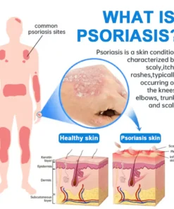 HOBENSUN® Magnesium Herbal Psoriasis Spray