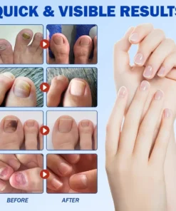 Heaceitr™ Anti-Fungal Nail Repair Patch
