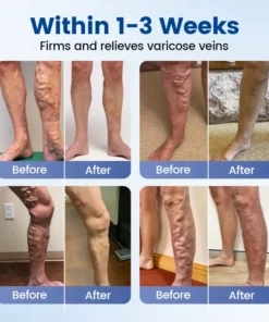 Timilk® Vein Ease Microneedle Therapy Patch