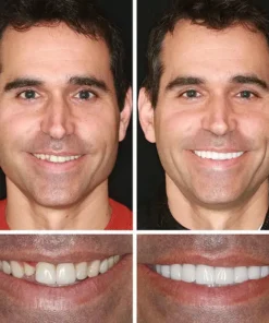 Yagoo™ Medical Full Denture with Strong Suctiond