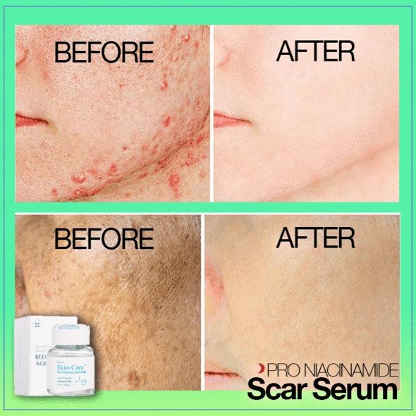 PRO Niacinamide Scar Serum - Image 4