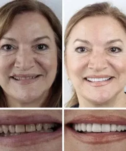 Meleval® Medical Full Denture with Strong Suctiond