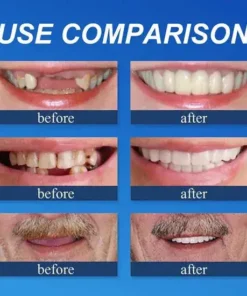 Meleval® Medical Full Denture with Strong Suctiond