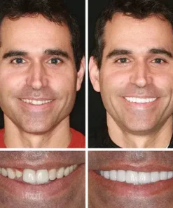Meleval® Medical Full Denture with Strong Suctiond