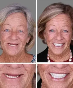 Meleval® Medical Full Denture with Strong Suctiond